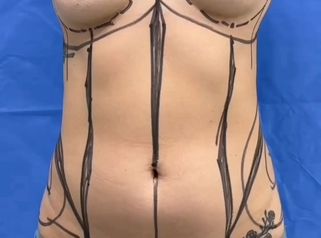 Cirugía Combinada Lipoescultura + Pexia con implantes - Cirugía Plástica Dieppa