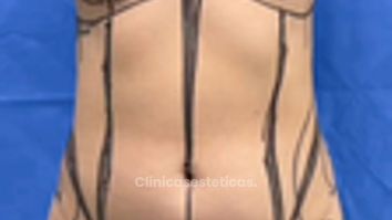 Cirugía Combinada Lipoescultura + Pexia con implantes - Cirugía Plástica Dieppa