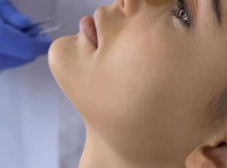 Rinoplastia - Dr. René Flores Aqueveque