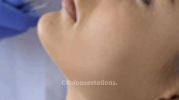 Rinoplastia - Dr. René Flores Aqueveque