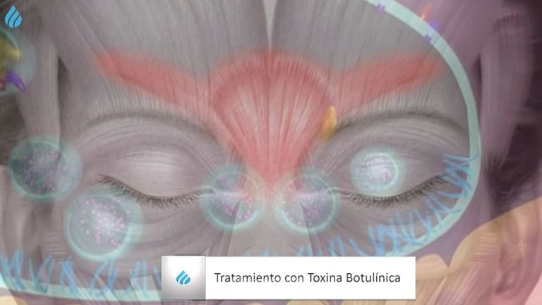 Toxina botulínica. Belmedic