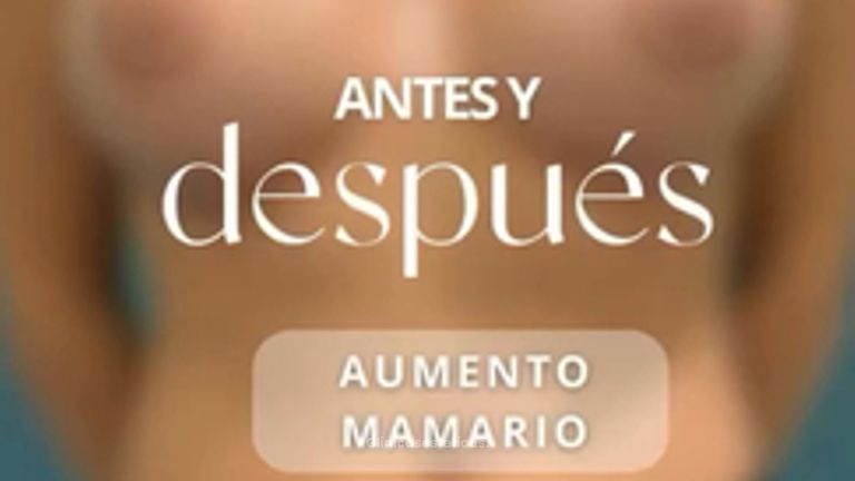 Beneficios en el aumento mamario - Dr. Vicente Sánchez Liberona