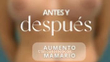 Beneficios en el aumento mamario - Dr. Vicente Sánchez Liberona