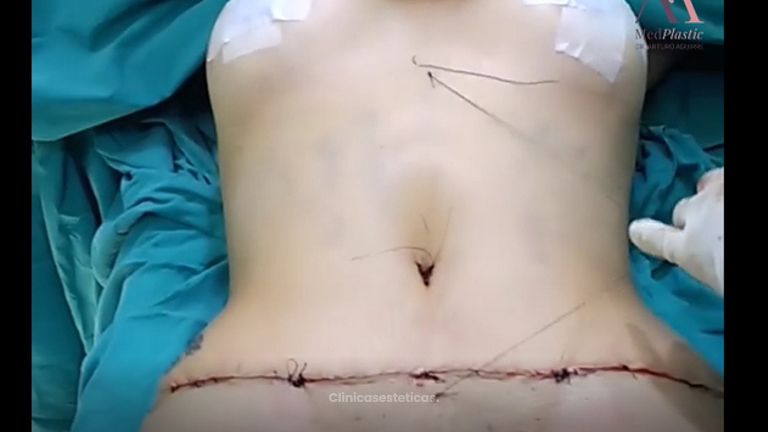Lipoabdominoplastia