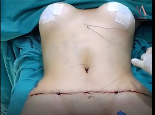 Lipoabdominoplastia