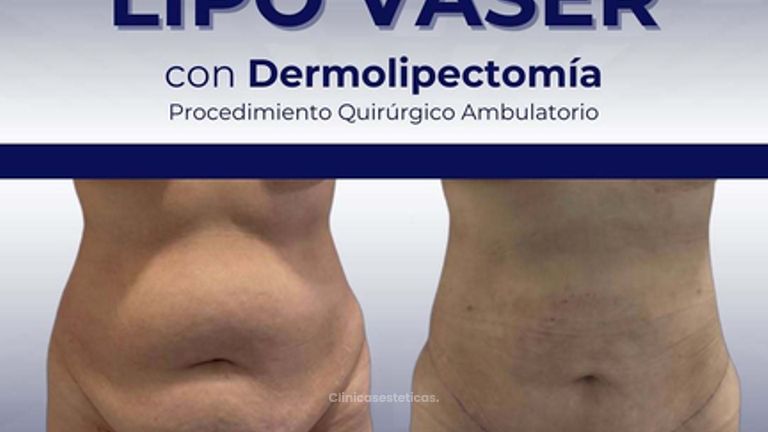 Lipo Vaser con Dermolipectomia - Clinica Bendov