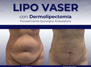 Lipo Vaser con Dermolipectomia - Clinica Bendov