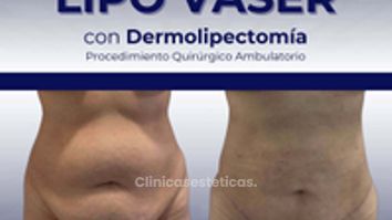 Lipo Vaser con Dermolipectomia - Clinica Bendov