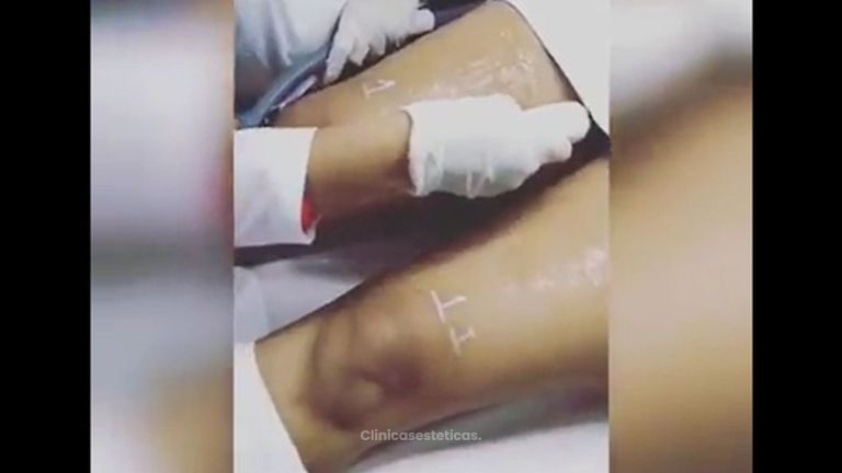 Tratamiento contra Arañas Vasculares 