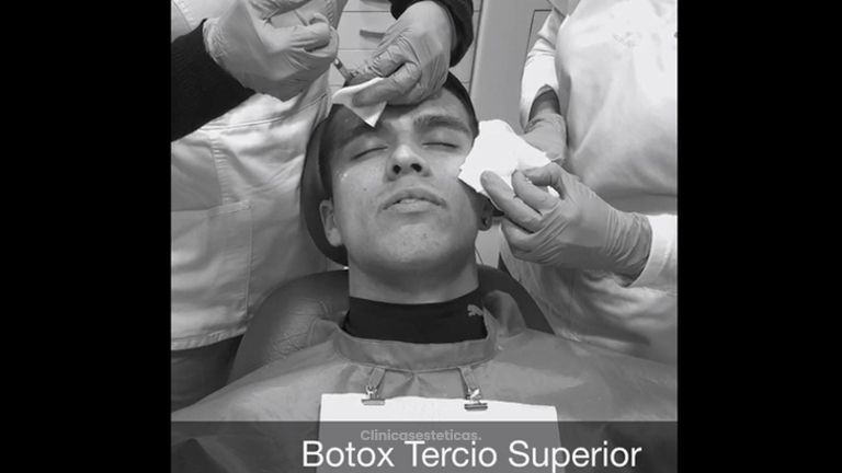 Bótox en tercio superior