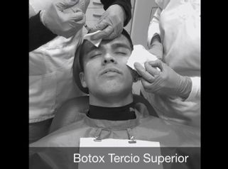 Bótox en tercio superior
