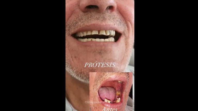 Implantes dentales - Dra. Katherin Ruiz Márquez