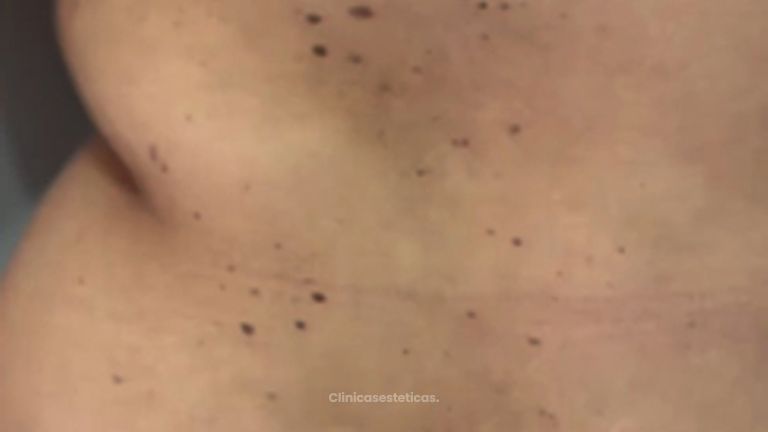 Abdominoplastia - Dr Christian Salem Zamorano