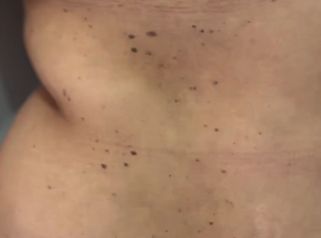 Abdominoplastia - Dr Christian Salem Zamorano