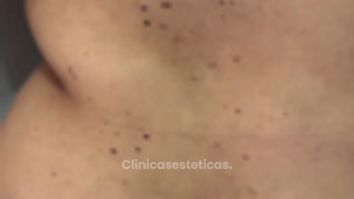 Abdominoplastia - Dr Christian Salem Zamorano