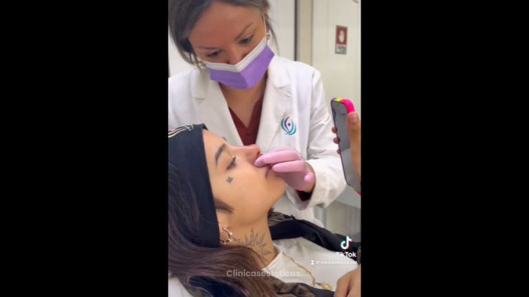 Aumento de labios - Medicina Estética Integral MD