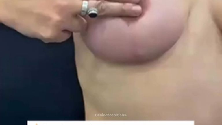 Mastopexia - Dr. Guillermo Santana