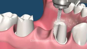 Así se coloca una prótesis para mejorar tu sonrisa