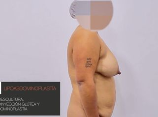Lipoabdominoplastía