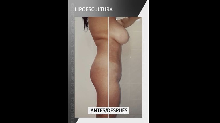Lipoescultura - Clínica Santiago Estética