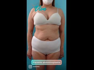 Abdominoplastia - Viveclinic