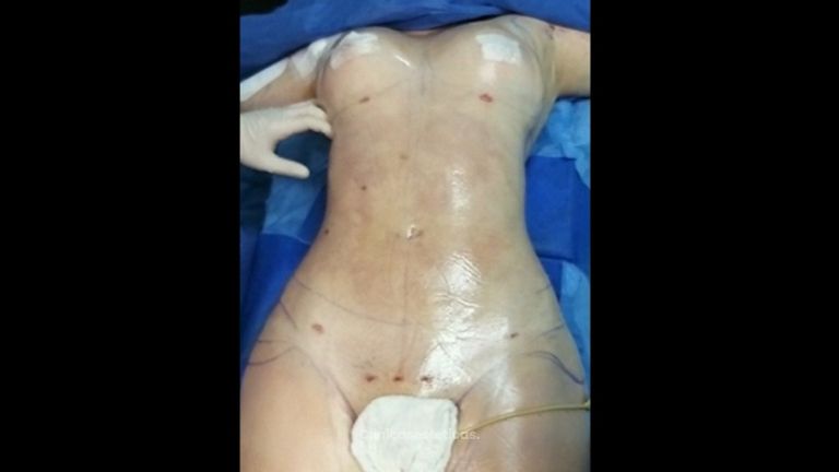Lipo Clinic By Dr Puchi Clínica De Lipoescultura Hd