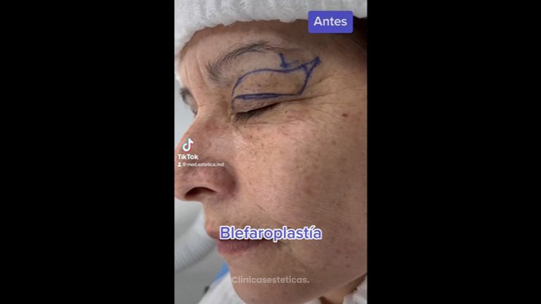 Blefaroplastia - Medicina Estética Integral MD
