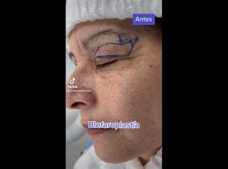 Blefaroplastia - Medicina Estética Integral MD