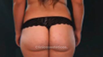 Lipoescultura - Dr. Matías Kufeke