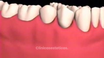 Coloca nuevos implantes y luce una mejor sonrisa