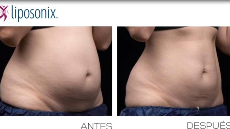 Liposonix