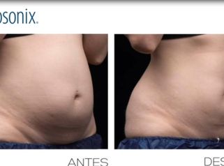 Liposonix