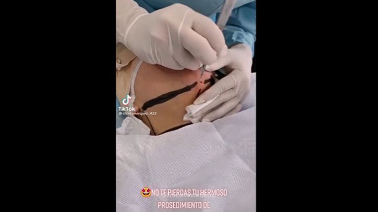Liposucción de papada - Dra. Katherin Ruiz Márquez