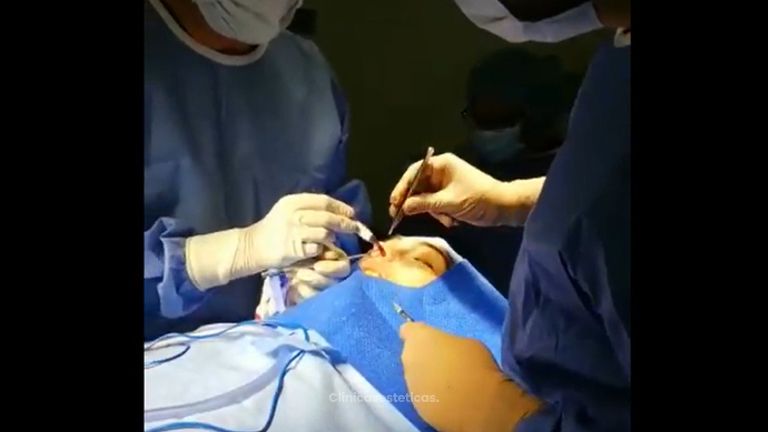 Rinoplastia - Dr. Rodrigo Pinto Carcamo