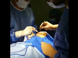 Rinoplastia - Dr. Rodrigo Pinto Carcamo