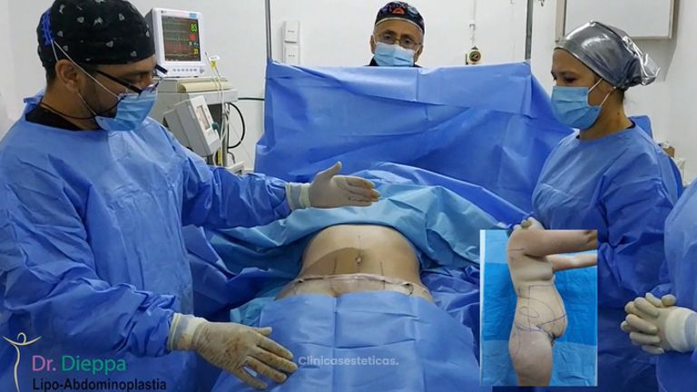 Lipoabdominoplastia - Cirugía Plástica Dieppa