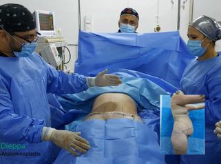 Lipoabdominoplastia - Cirugía Plástica Dieppa