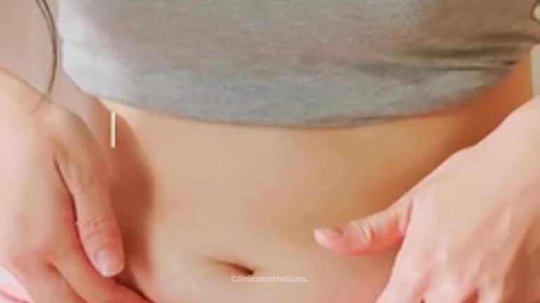 Abdominoplastia - Dr. René Flores Aqueveque