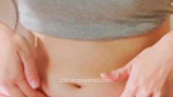 Abdominoplastia - Dr. René Flores Aqueveque