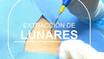 Extracción de lunares