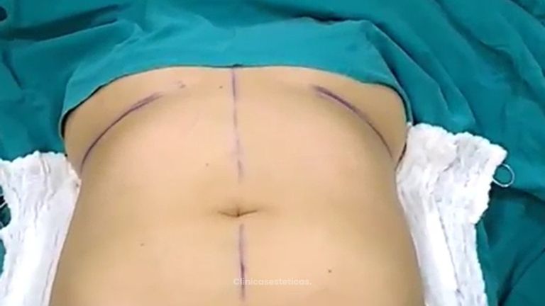 Lipoabdominoplastia