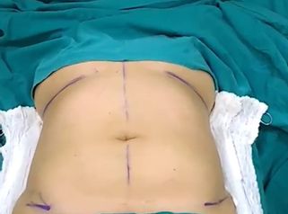 Lipoabdominoplastia