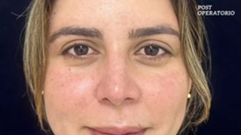 Rinoplastia - Dra. Angélica Sifontes Muñoz