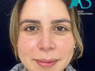 Rinoplastia - Dra. Angélica Sifontes Muñoz