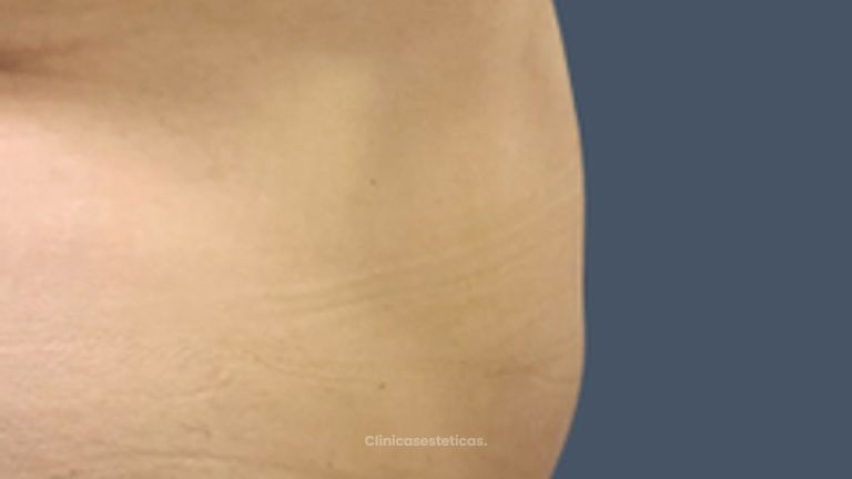 Abdominoplastia - Dr. Nadir Carda