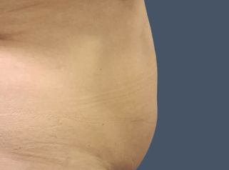 Abdominoplastia - Dr. Nadir Carda