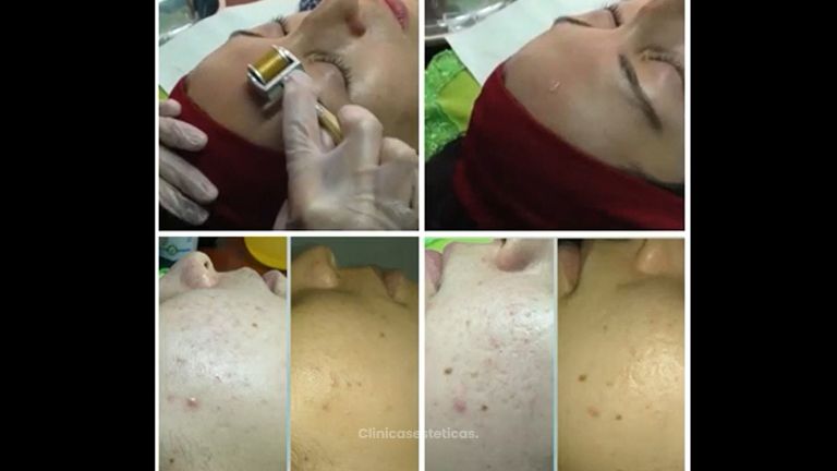 Tratamiento acné - Skinestetic