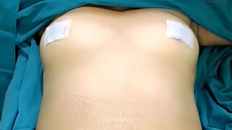 Lipoabdominoplastia