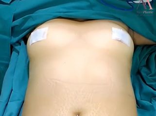 Lipoabdominoplastia