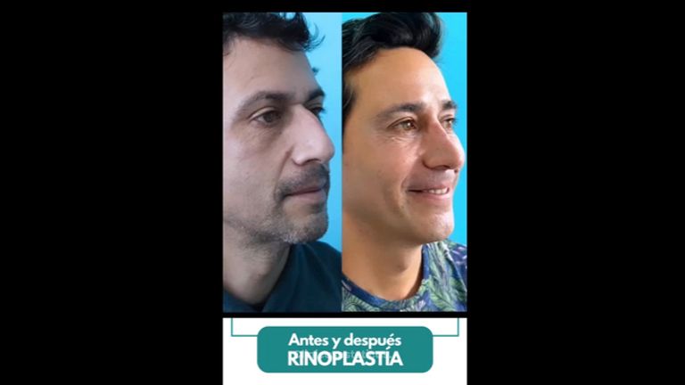 Rinoplastia - Dr. Pedro Vidal G-H